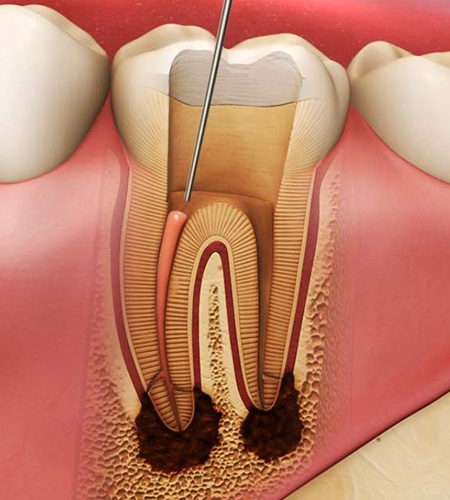 Root-Canal-Treatment