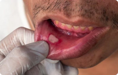 Canker Sores and Lesions