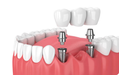 Dental Implants