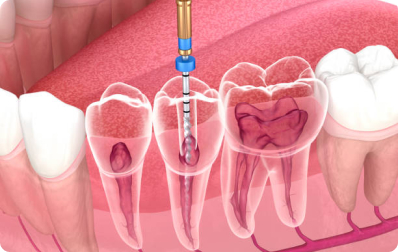 Endodontic Retreatment