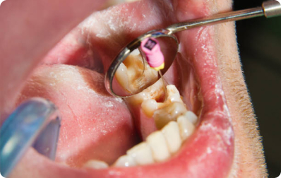 Regenerative Endodontics