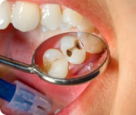 Tooth Decay or Cavities