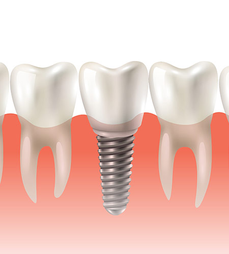 Dental Implants