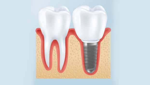 Dentures-implant-supported-immer