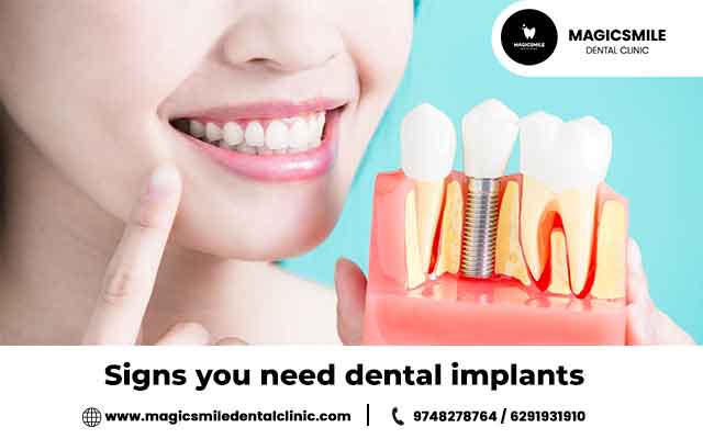 Signs You Need Dental Implants