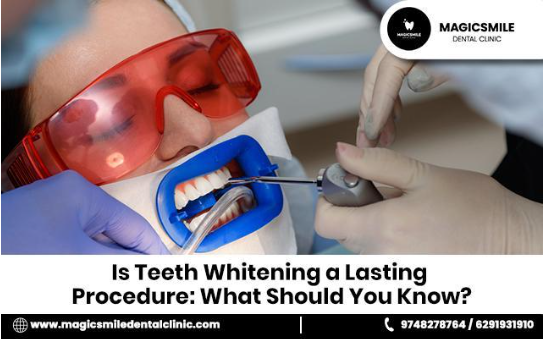 Is Teeth Whitening a Lasting Procedure: What Should You Know?