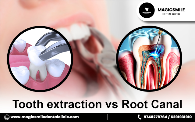 Tooth extraction vs Root Canal