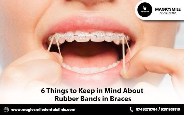 6 Things to Keep in Mind about Rubber Bands in Braces