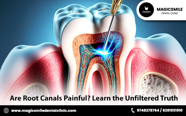 Are Root Canals Painful? Learn the Unfiltered Truth