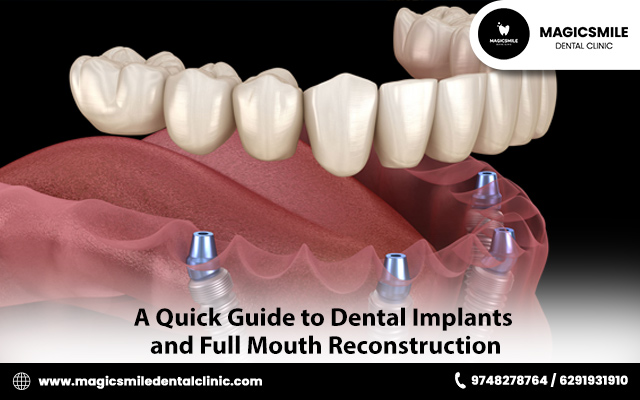 dental implant prosthetics