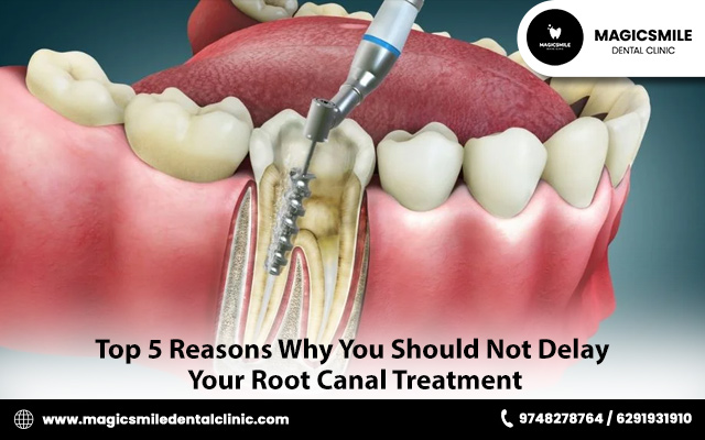 Top 5 Reasons Why You Should Not Delay Your Root Canal Treatment