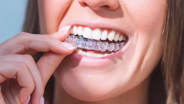 Clear Aligners