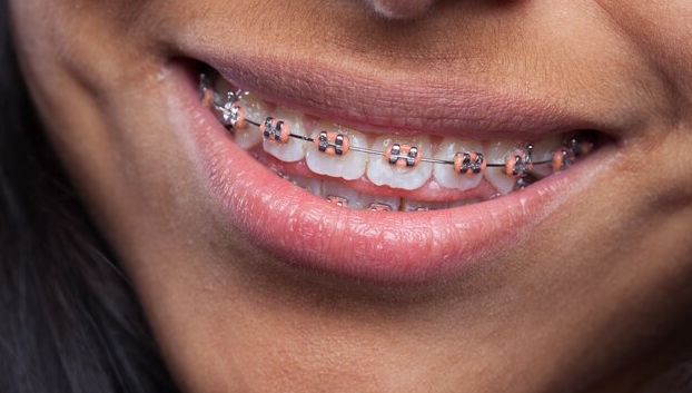 Lingual Braces