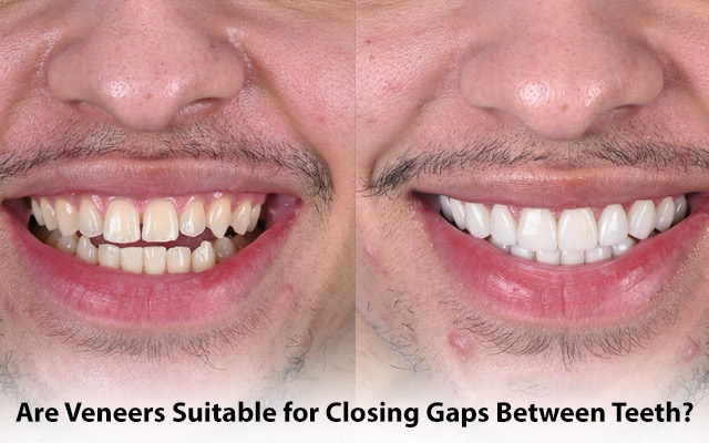 Are Veneers Suitable for Closing Gaps Between Teeth?