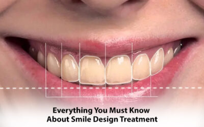 Everything You Must Know About Smile Design Treatment