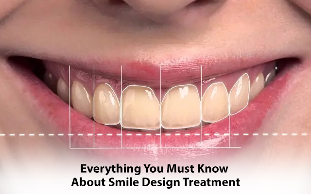 Everything You Must Know About Smile Design Treatment