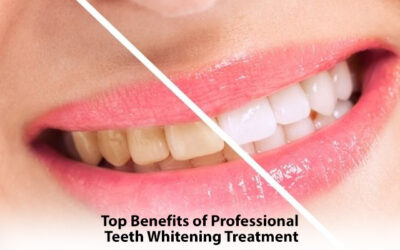  Top Benefits of Professional Teeth Whitening Treatment