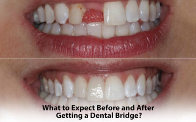 What to Expect Before and After Getting a Dental Bridge?