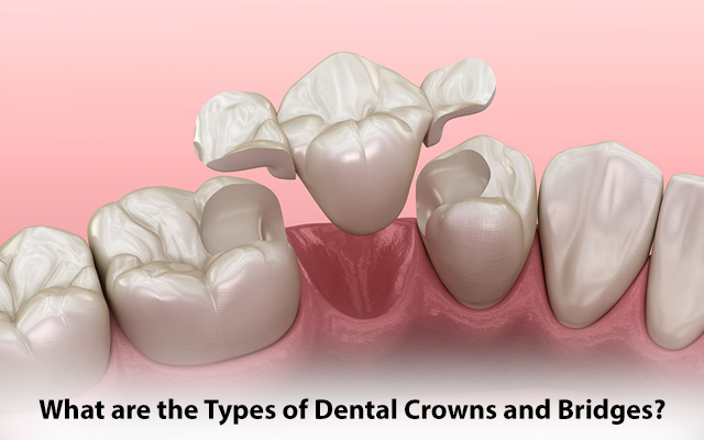 What are the Types of Dental Crowns and Bridges?