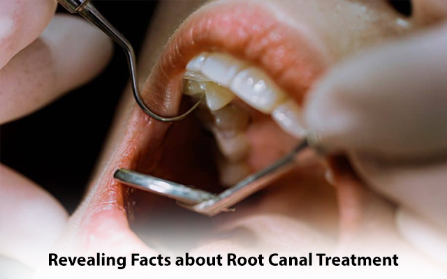 Revealing Facts about Root Canal Treatment