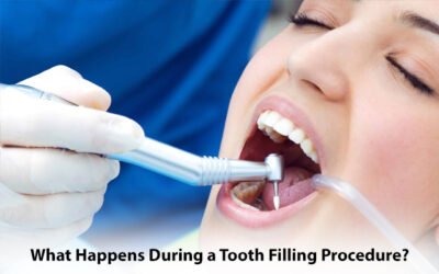 What Happens During a Tooth Filling Procedure?