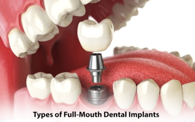 Types of Full-Mouth Dental Implants