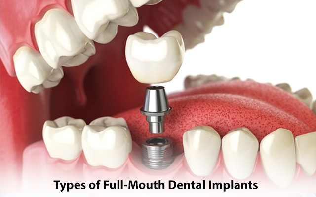 dental implants in newtown