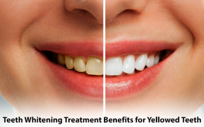 Teeth Whitening Treatment Benefits for Yellowed Teeth