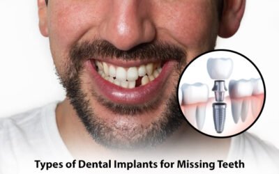 Types of Dental Implants for Missing Teeth