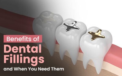 Benefits of Dental Fillings and When You Need Them