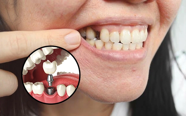 Tooth Missing? Why Delaying Dental Implants Can Damage Nearby Teeth