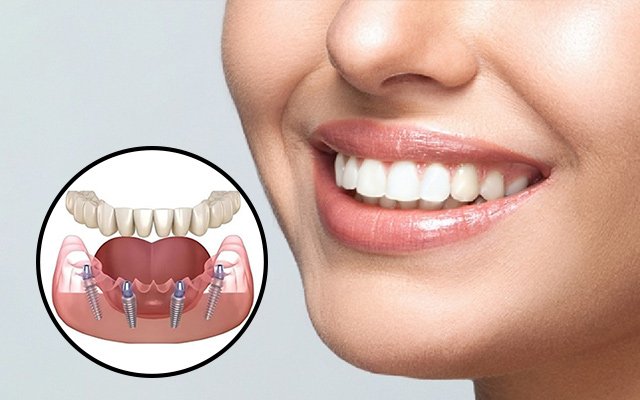 Dental Implant Cost in Kolkata